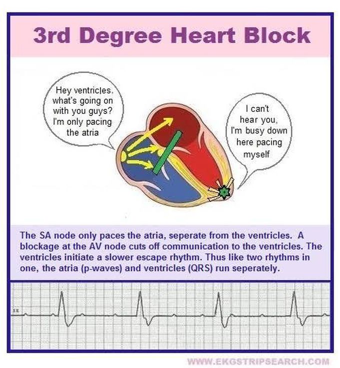 3rd Degree AV Block