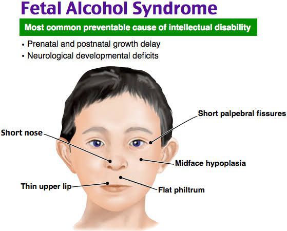 Fetal Alcohol Syndrome Medizzy