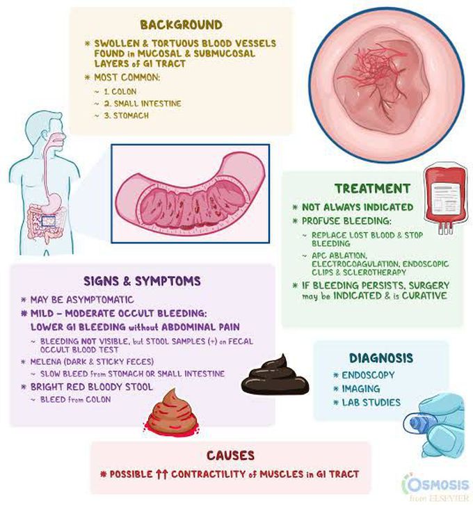 Angiodysplasia - Medizzy