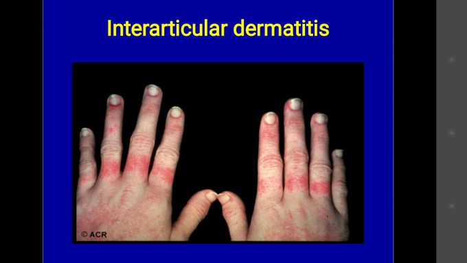 In which rheumatologic disease we see this sign ??