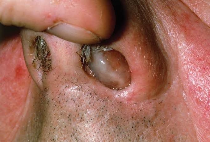 Symptoms of nasal polyps