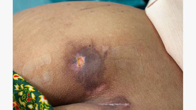 Pressure Sores