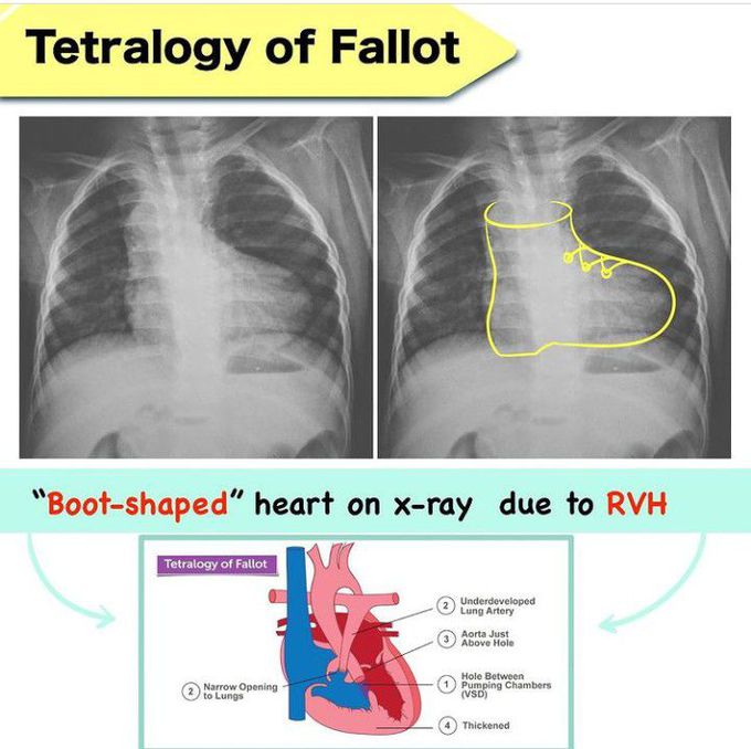 Tetralogy of Fallot -Boot shaped heart