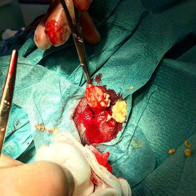 Removing a sebaceus cyst from patient's head