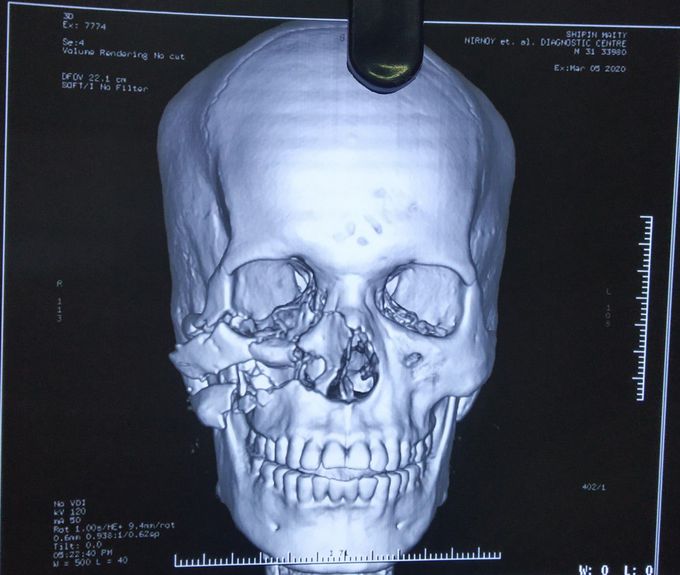 3D reconstruction, maxillary #