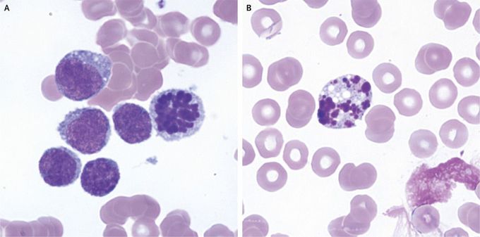Mitotic and Apoptotic Figures on a Peripheral-Blood Smear