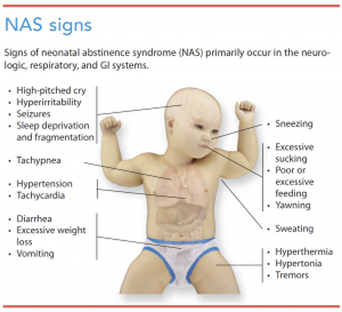 Signs of Neonatal Abstinence Syndrome