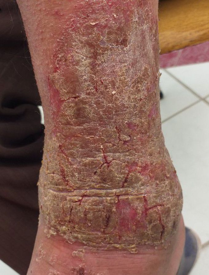 what is your diagnosis? what is the treatment?