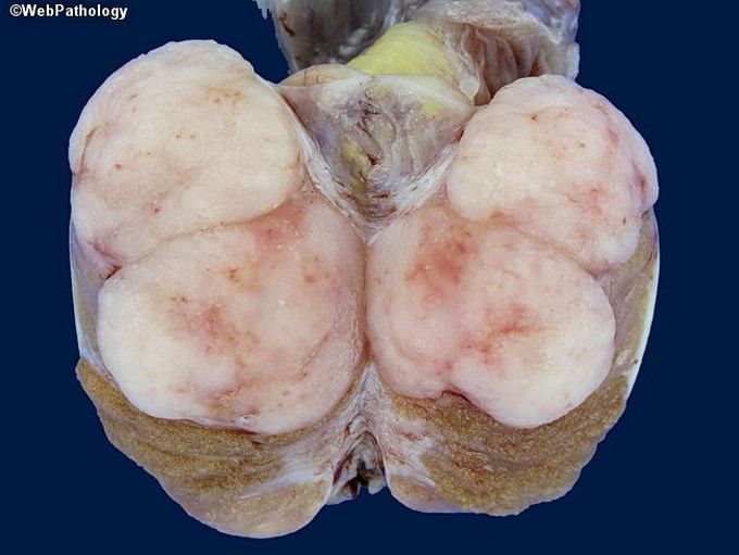 Seminoma