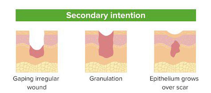 Secondary intention of healing