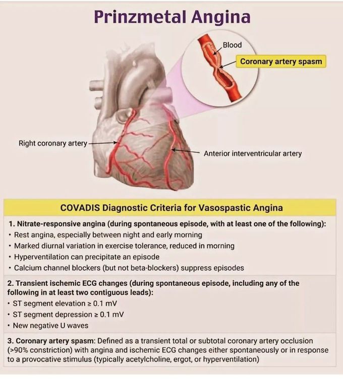 Prinzmetal Angina