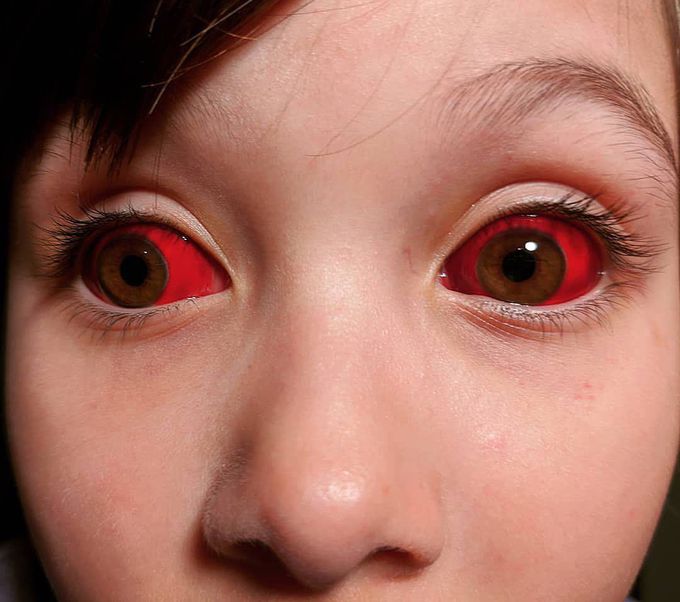 Case of a subconjunctival bleeding in an otherwise healthy child