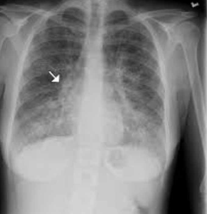 Pulmonary cancer first stade