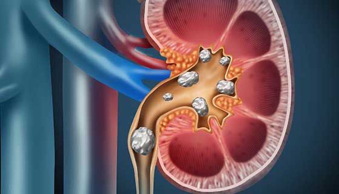 What Are Kidney Stones?

Kidney stones are hard pebble-like objects that can form inside your kidneys. They’re made of minerals and salts. You might hear your doctor call them renal calculi, nephrolithiasis, or urolithiasis.

Kidney stones are small -- usually between the size of a kernel of corn and a grain of salt. They can form when your body has too much of certain minerals, and at the same time doesn’t have enough liquid. The stones can be brown or yellow, and smooth or rough.