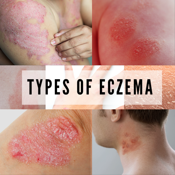 Eczema