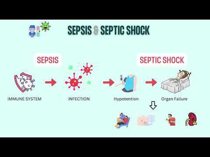 Sepsis and septic shock