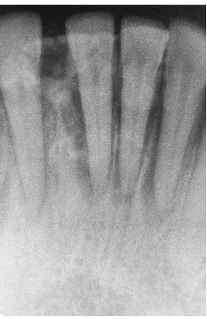 Osteosarcoma