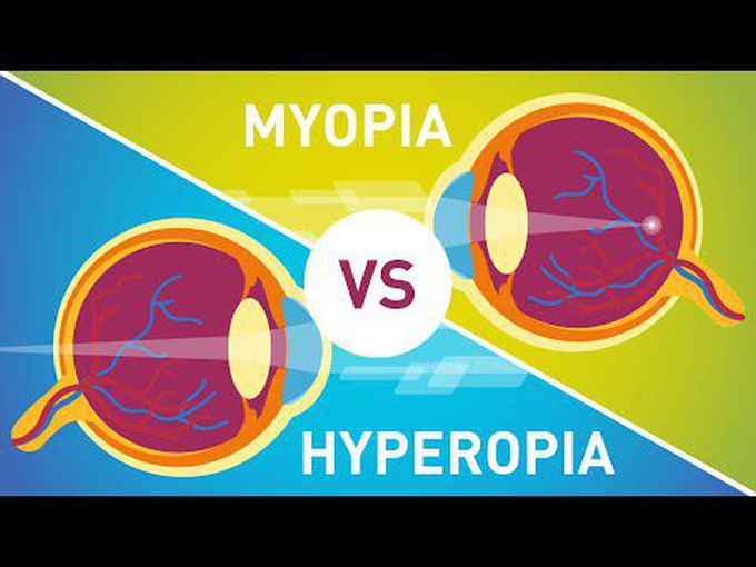 Special senses:
Myopia and Hypermetropia