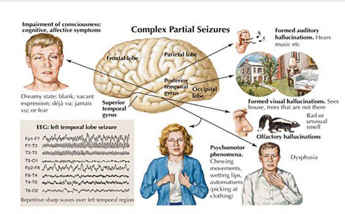 Complex Partial Seizures