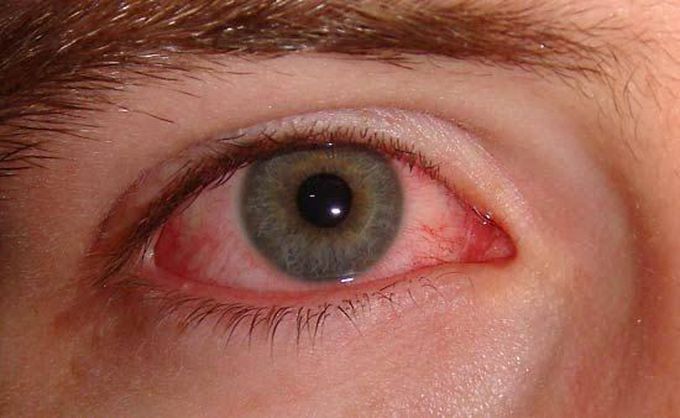 Symptoms of conjunctivitis