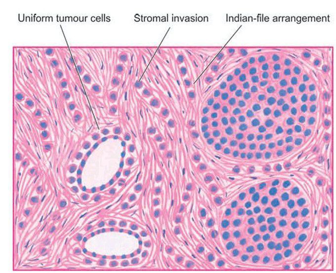 Invasive lobular carcinoma.