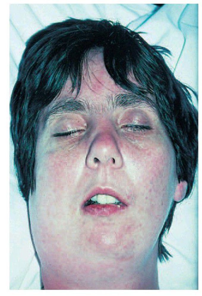 Ludwig’s angina.