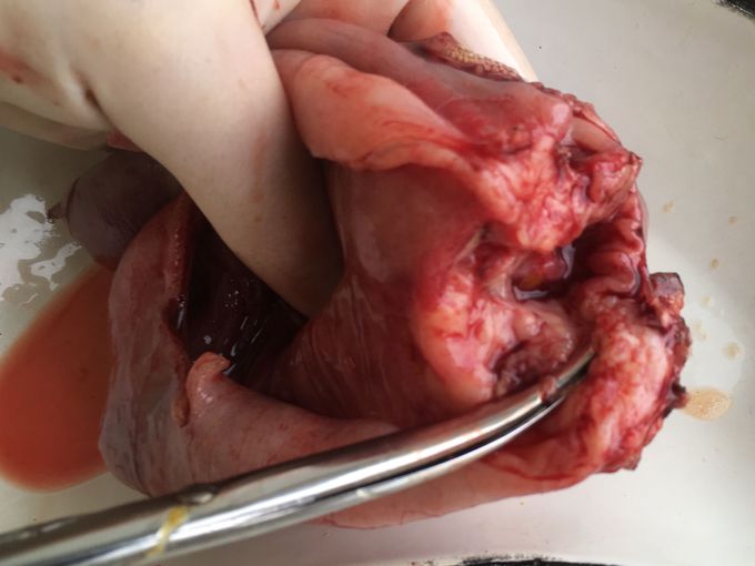 Removed cancer of small intestine.