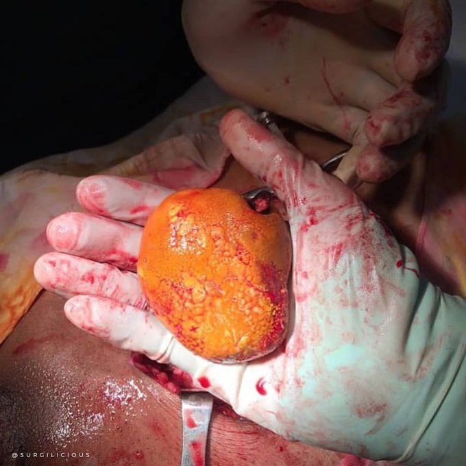 An apple-like bladder stone