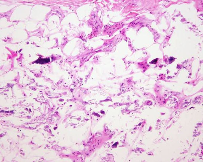 Metastatic calcification