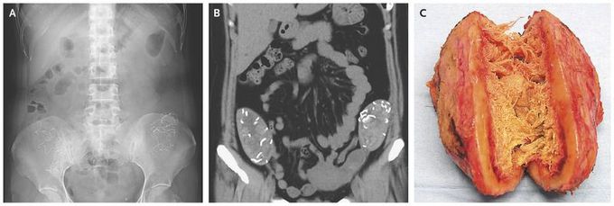 Two Pelvic Masses