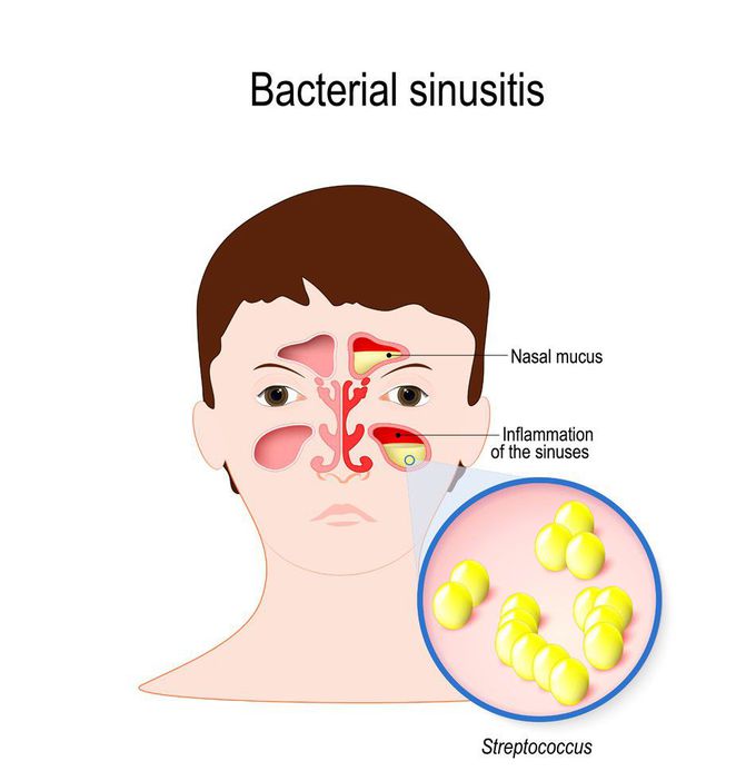 Bacterial sinusitis