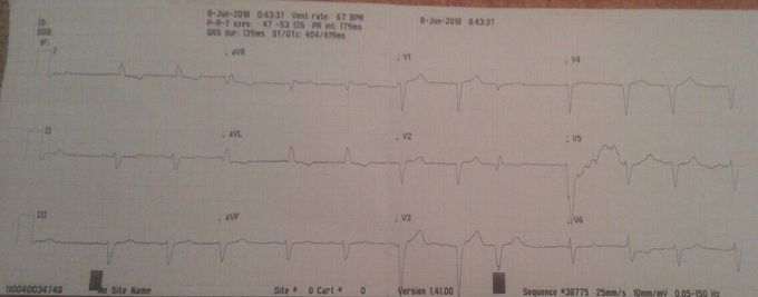 Ecg dm