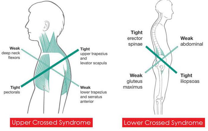 These are the types of Cross syndrome