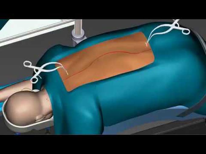 Spinal Curvature Surgery || Spine Surgery Animation