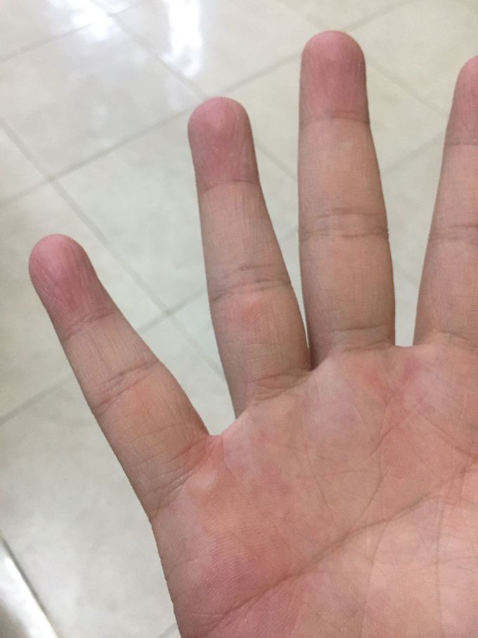 What is this dianosis?