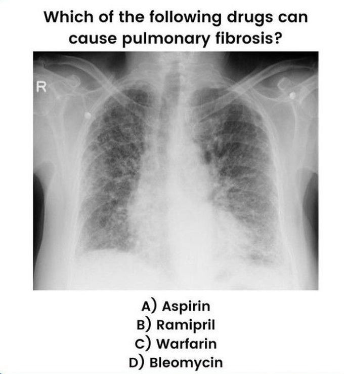 Pulmonary Fibrosis Causing Drug