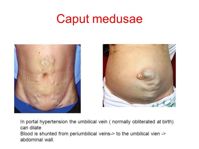 Treatment for Caput medusae