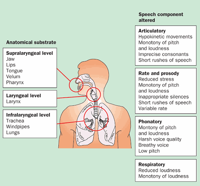Hypokinetic dysarthria