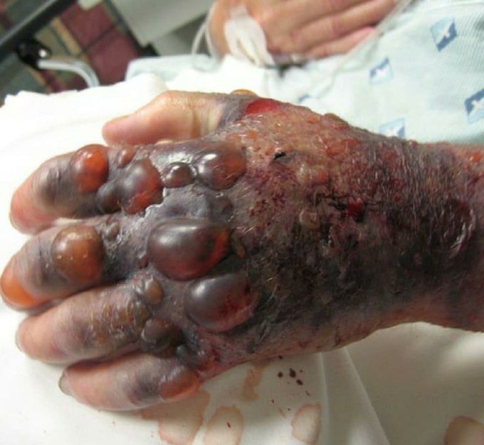 Purple glove syndrome