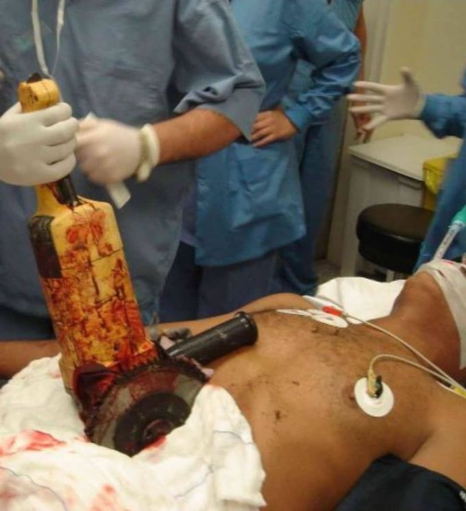 Unfortunate mishap left a farmer with circular power saw embedded in his stomach