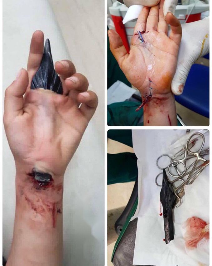 Pierced through the hand with a spearhead! 