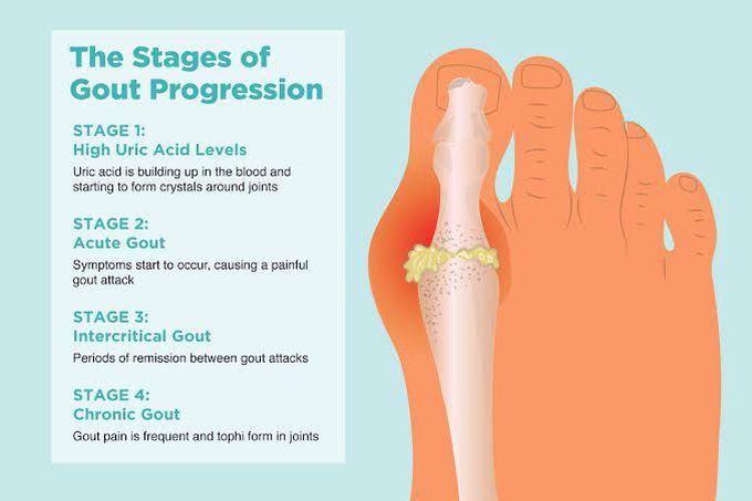 Stages of Gout