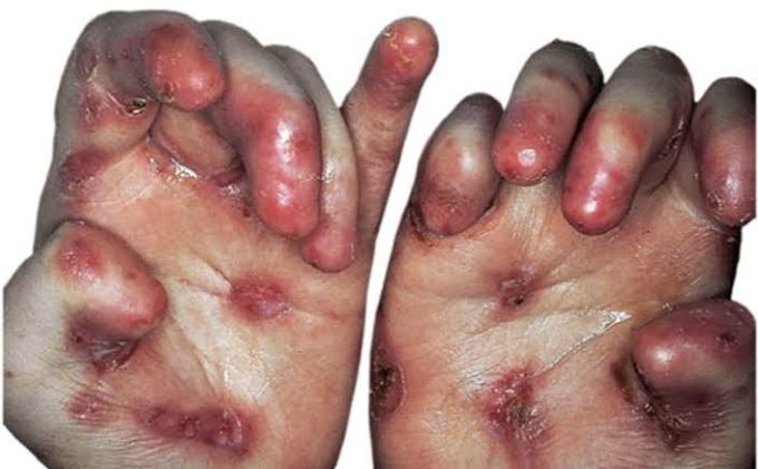 Epidermolysis Bullosa-Treatment