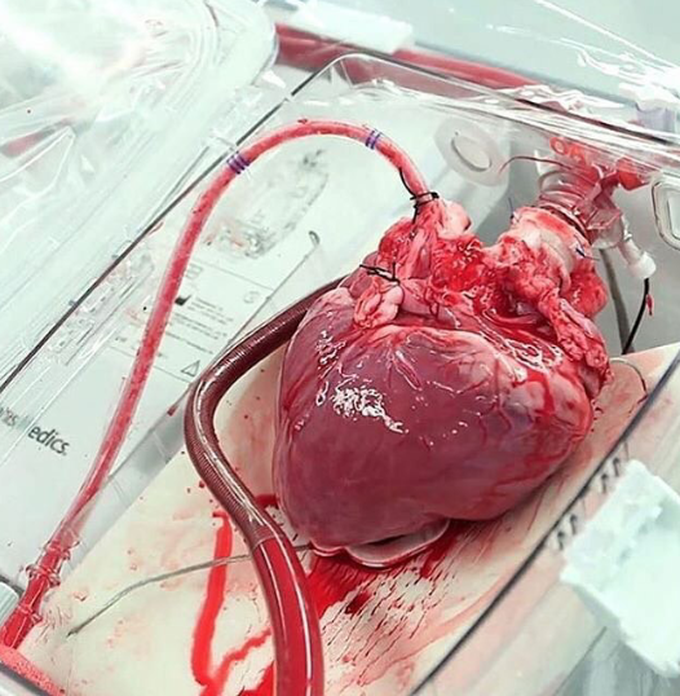 Heart transplantation