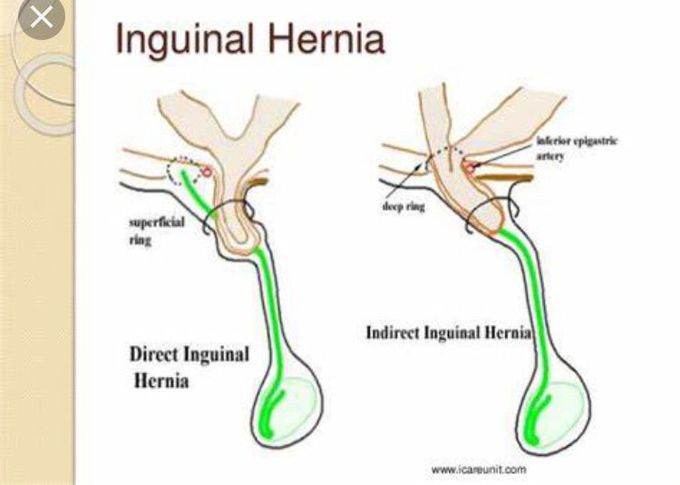 Direct hernia pass via superficial inguinal ring.          Indirect hernia pass via deep inguinal ring.