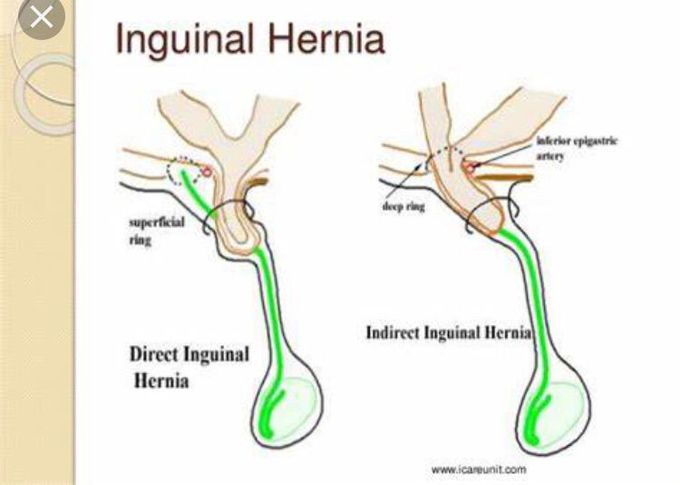 superficial inguinal ring