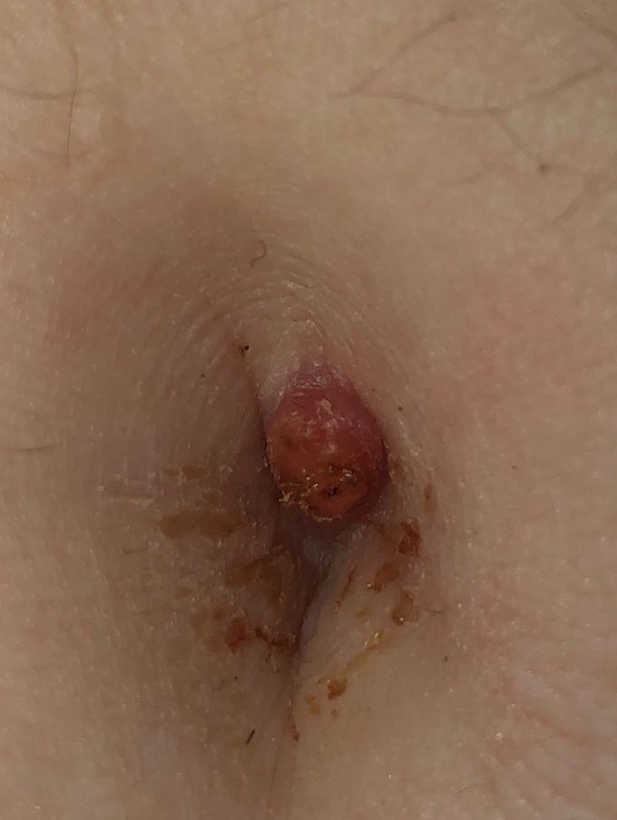 Cyst?