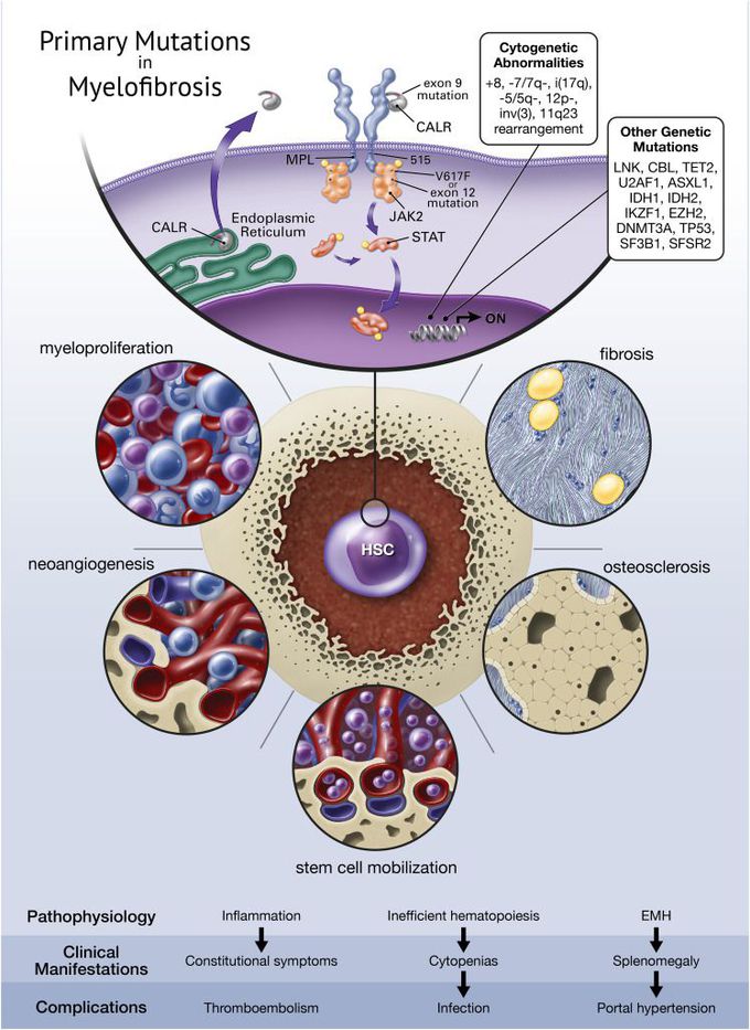 Myelofibrosis