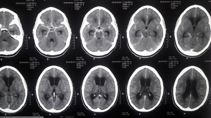 CT-Brain