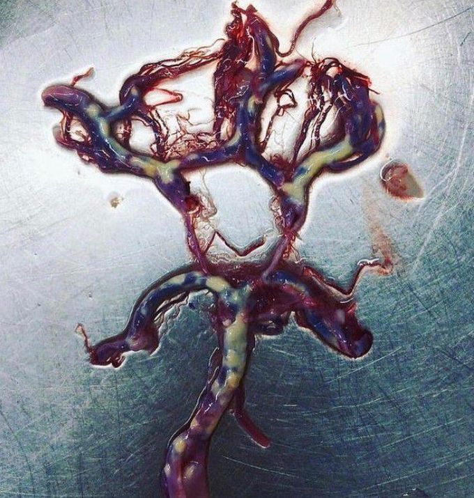 A rare specimen of Circle of Willis